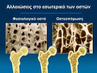 τι ειναι η οστεοπορωση